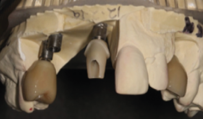 Getting the ultimate clinical and aesthetic results using flex-base zirconia abutments