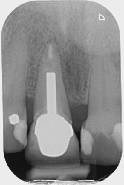 Fig 1- Shows the RCT of UR1