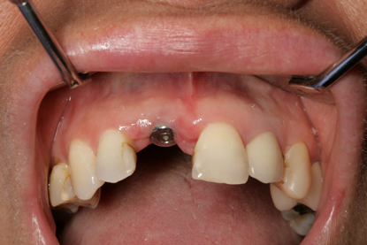 Fig 3 Implant placed and sulcus former in situ