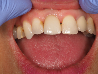 Fig 7: And three months post fit unfortunately the mesial papilla had receeded but we had maintained the distal.