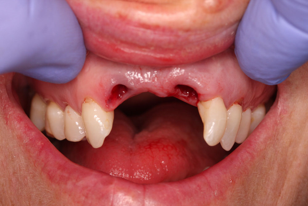 2.tooth-extraction
