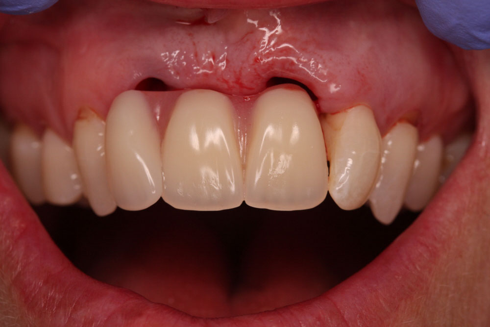 3.immediate-temp-denture