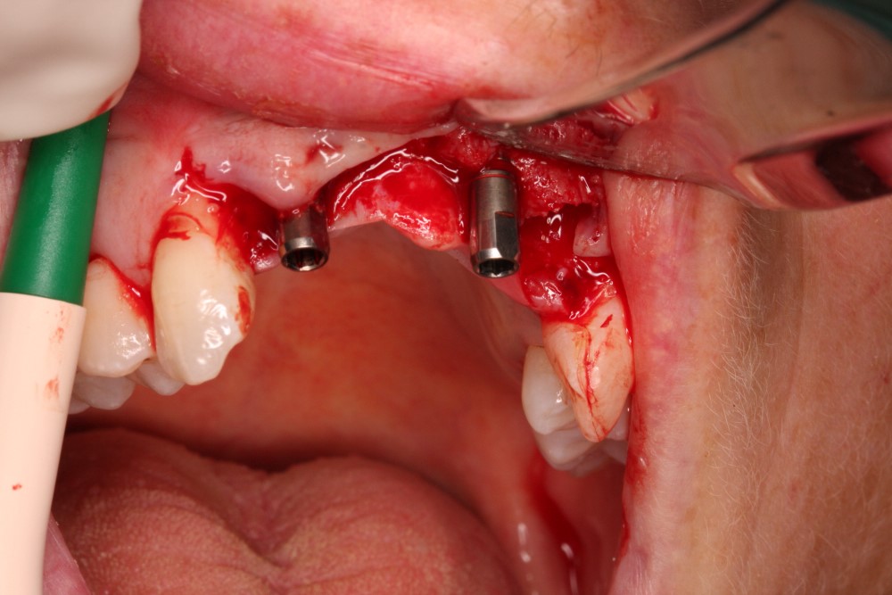 4.implant placement copy