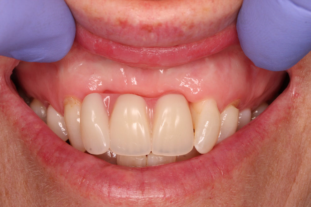 6.second-temp-denture