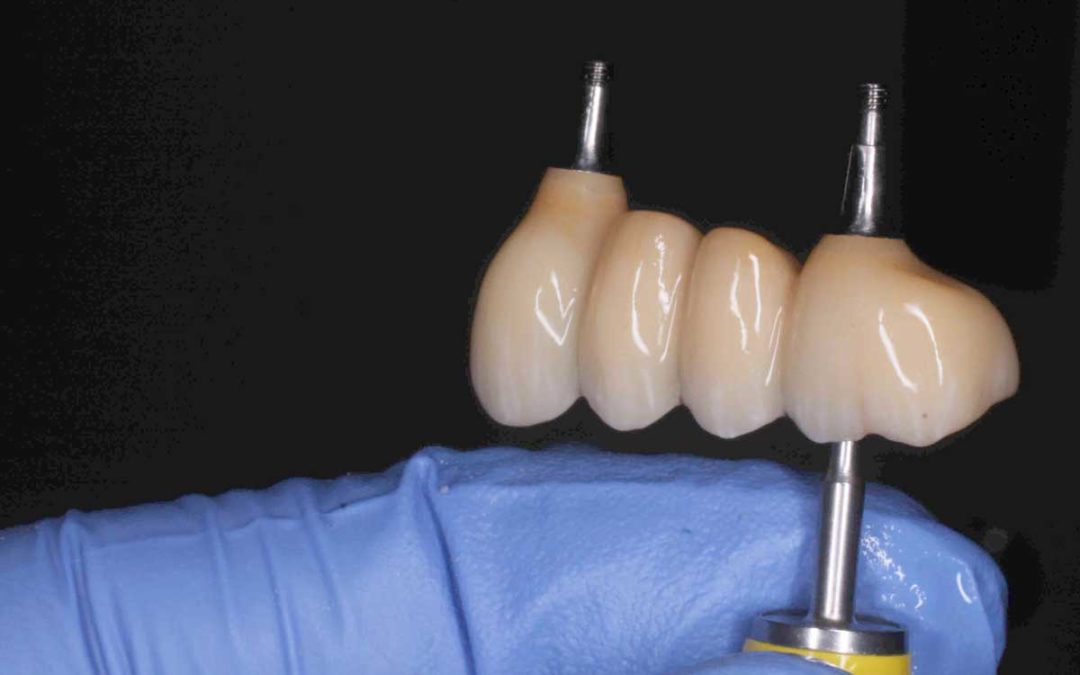 UL3-6 screw-retained implant bridge with UR4 and UR6 single screw retained crowns
