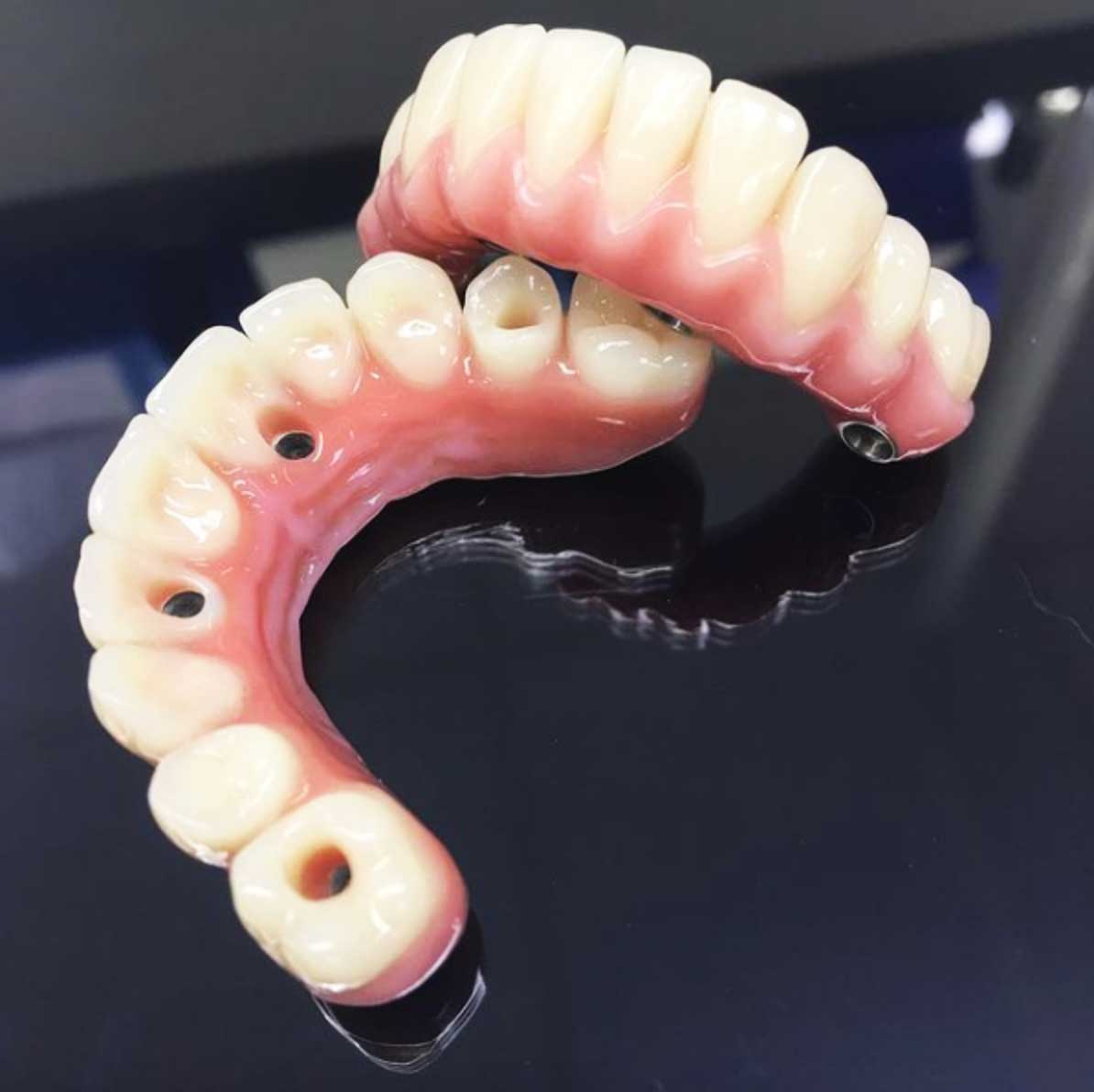 Acrylic-and-composite-hybrid-wrap-with-Phonares-II-acrylic-teeth-and-custom-milled-titanium-substructure.