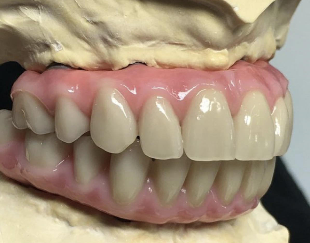 Acrylic hybrid wrap with Phonares II acrylic teeth and custom milled titanium substructure.