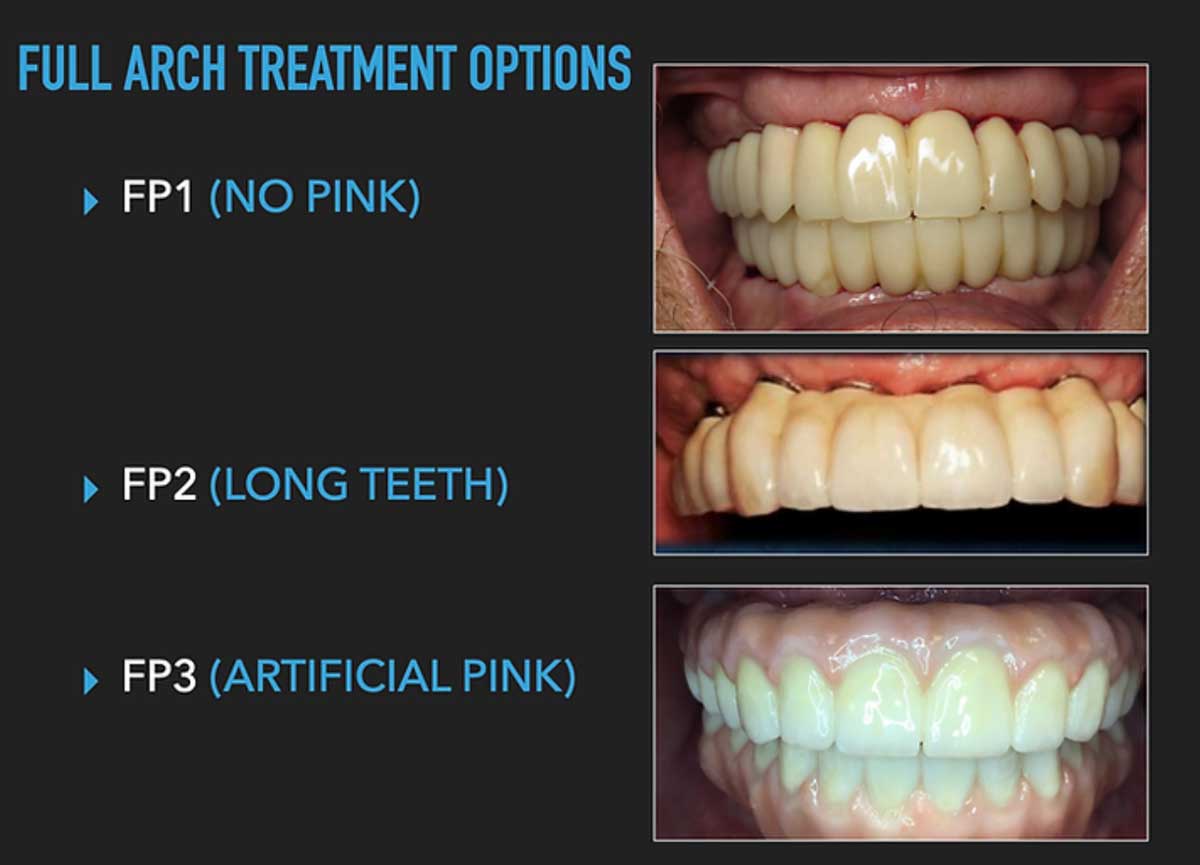 photo-source-full-arch-treatment-options