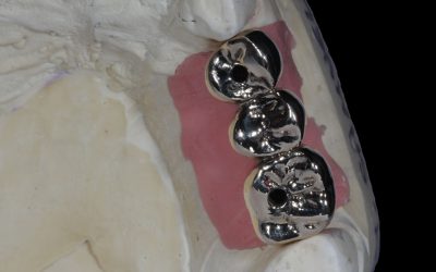 21g gold bridge laser sintered by Skillbond on Ankylos screw-retained Ti-bases